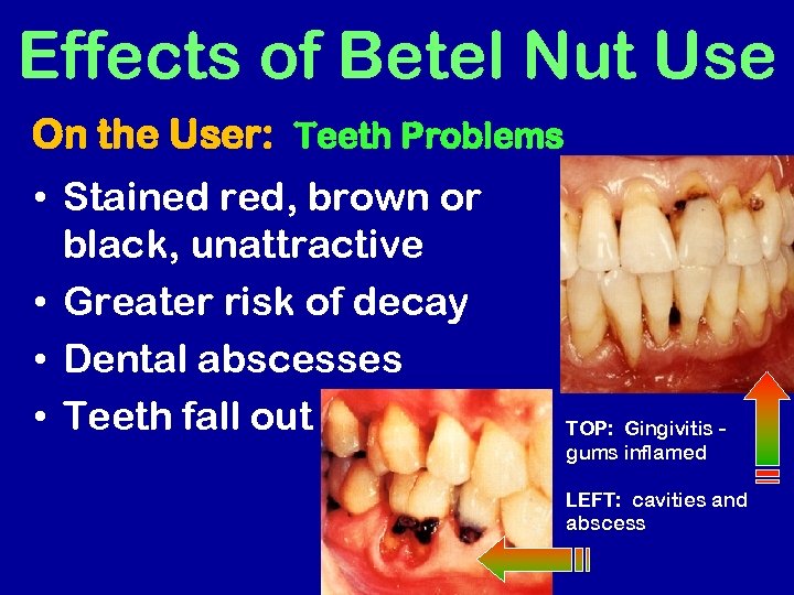Effects of Betel Nut Use On the User: Teeth Problems • Stained red, brown