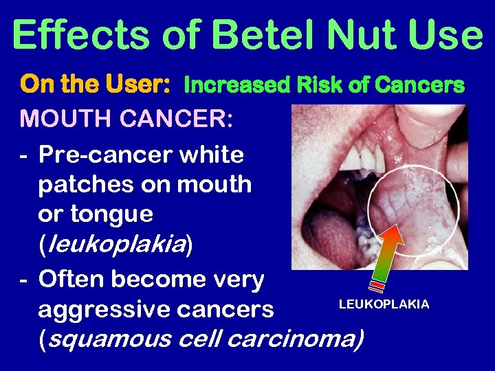 Effects of Betel Nut Use On the User: Increased Risk of Cancers MOUTH CANCER: