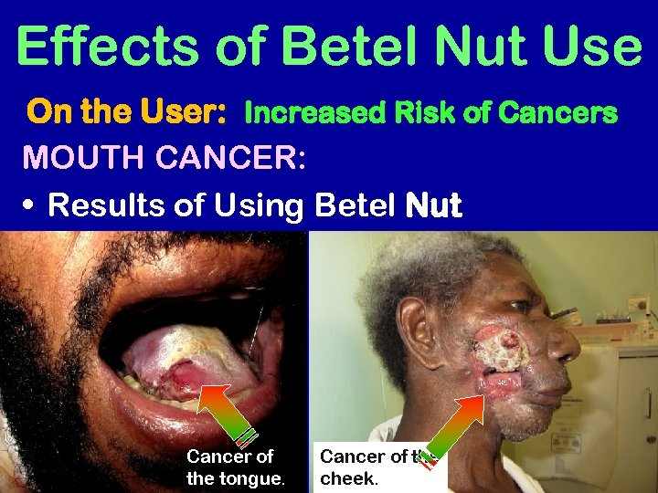 Effects of Betel Nut Use On the User: Increased Risk of Cancers MOUTH CANCER: