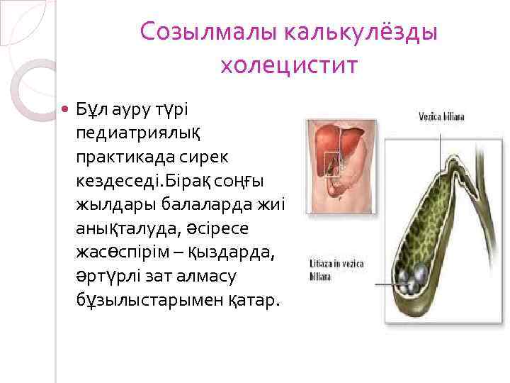 Созылмалы калькулёзды холецистит Бұл ауру түрі педиатриялық практикада сирек кездеседі. Бірақ соңғы жылдары балаларда