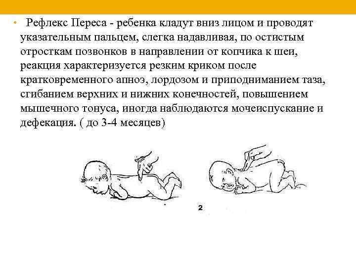  • Рефлекс Переса - ребенка кладут вниз лицом и проводят указательным пальцем, слегка