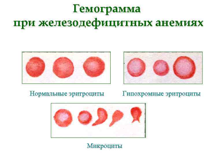 Гемограмма при железодефицитных анемиях Нормальные эритроциты Микроциты Гипохромные эритроциты 