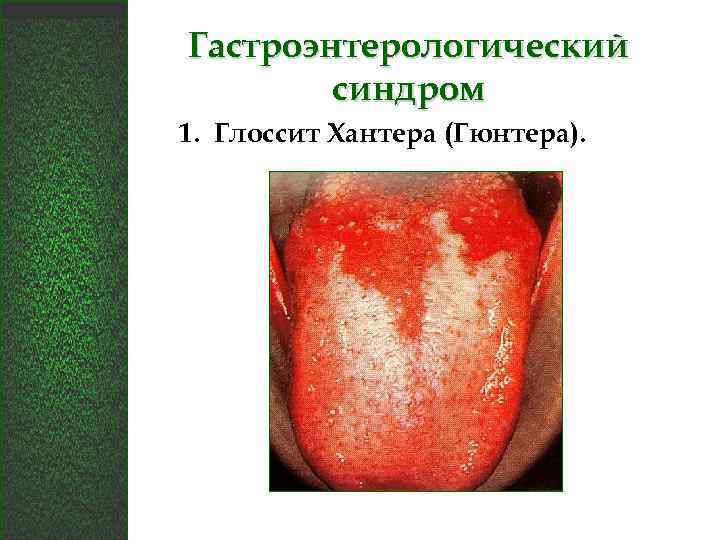 Гастроэнтерологический синдром 1. Глоссит Хантера (Гюнтера). 