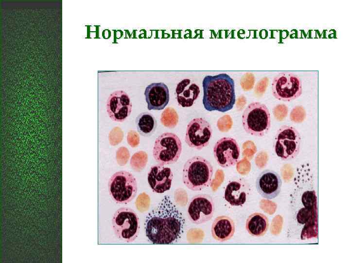 Миелограмма костного мозга. Цитологическое исследование костного мозга миелограмма. Нормальная миелограмма. Нормальная миелограмма костного мозга. Норма миелокариоцитов в костном мозге.