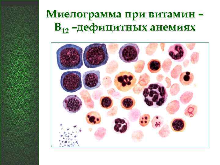 Миелограмма при витамин – В 12 –дефицитных анемиях 