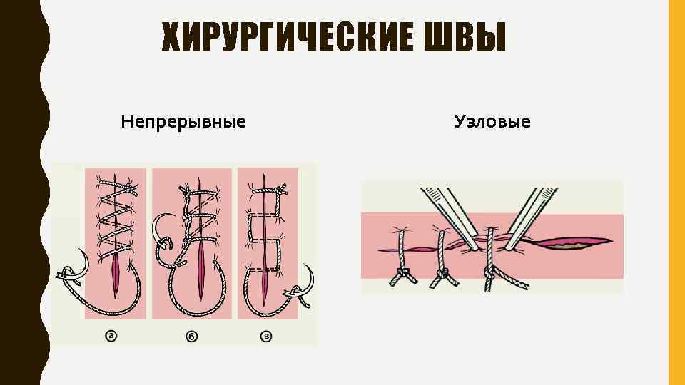 Виды швов хирургия фото