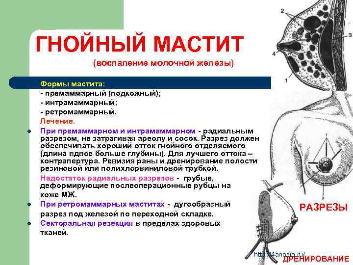 ГНОЙНЫЙ МАСТИТ (воспаление молочной железы) l l Формы мастита: - премаммарный (подкожный); - интрамаммарный;