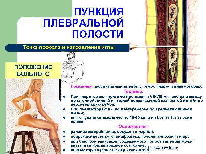 ПУНКЦИЯ ПЛЕВРАЛЬНОЙ ПОЛОСТИ Точка прокола и направление иглы ПОЛОЖЕНИЕ БОЛЬНОГО Показания: эксудативный плеврит, гемо-,