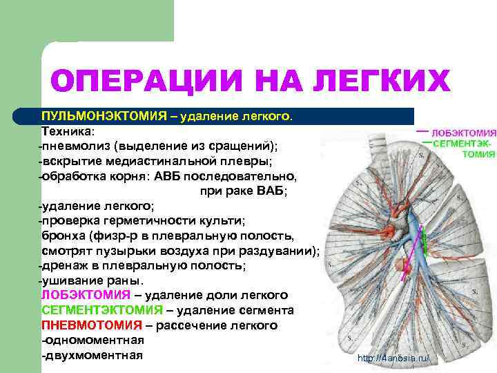 ОПЕРАЦИИ НА ЛЕГКИХ ПУЛЬМОНЭКТОМИЯ – удаление легкого. Техника: -пневмолиз (выделение из сращений); -вскрытие медиастинальной