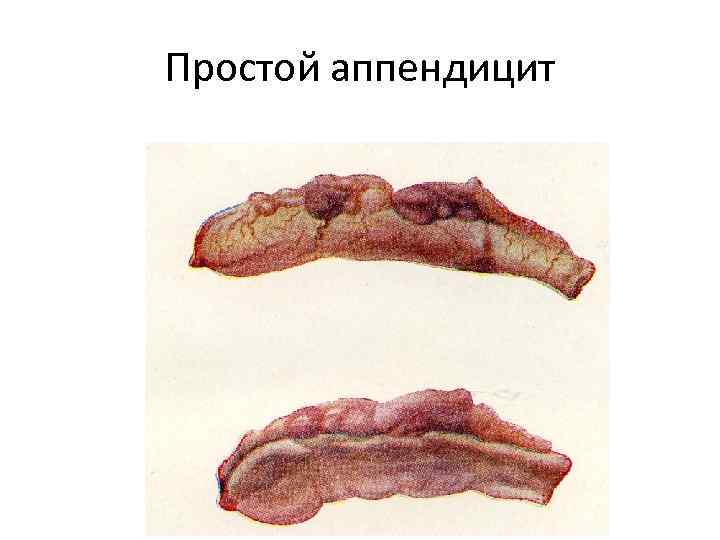 Простой аппендицит 