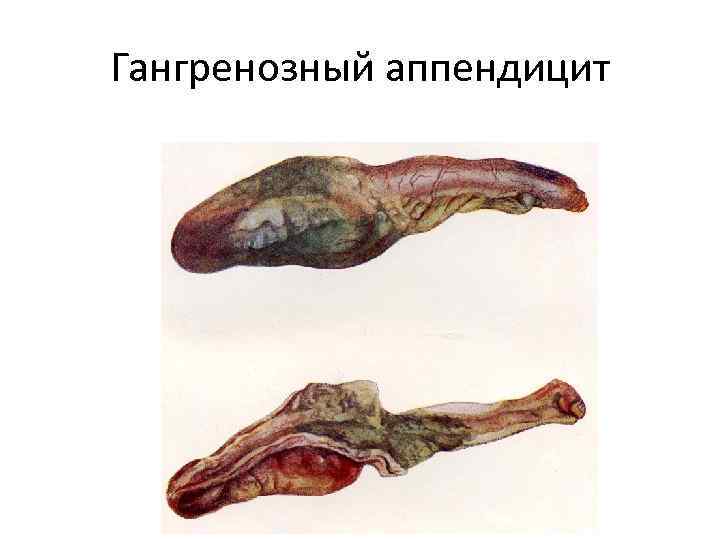 Гангренозный аппендицит 