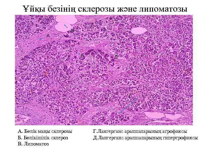 Ұйқы безінің склерозы және липоматозы А В Б Д Г А. Бөлік маңы склерозы