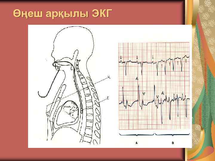 Өңеш арқылы ЭКГ 