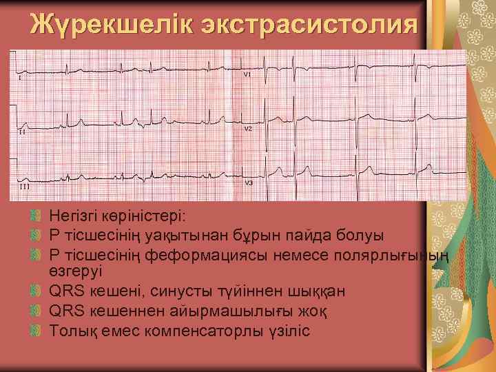 Жүрекшелік экстрасистолия Негізгі көріністері: Р тісшесінің уақытынан бұрын пайда болуы Р тісшесінің феформациясы немесе