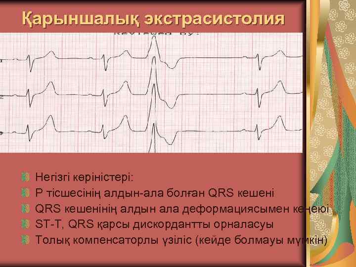 Қарыншалық экстрасистолия Негізгі көріністері: Р тісшесінің алдын-ала болған QRS кешенінің алдын ала деформациясымен кеңеюі