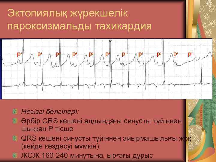 Эктопиялық жүрекшелік пароксизмальды тахикардия Негізгі белгілері: Әрбір QRS кешені алдындағы синусты түйіннен шыққан Р