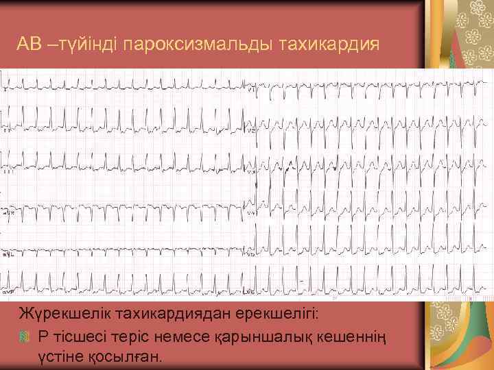 АВ –түйінді пароксизмальды тахикардия Жүрекшелік тахикардиядан ерекшелігі: Р тісшесі теріс немесе қарыншалық кешеннің үстіне