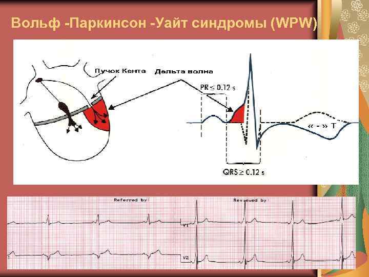 Вольф -Паркинсон -Уайт синдромы (WPW) 