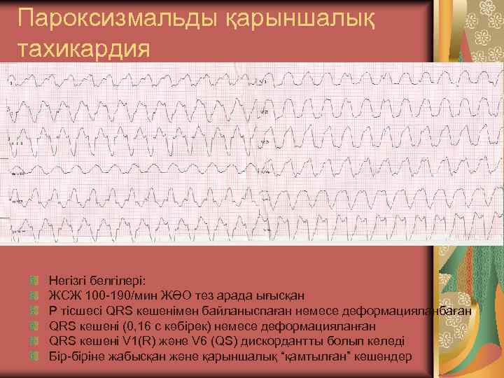 Пароксизмальды қарыншалық тахикардия Негізгі белгілері: ЖСЖ 100 -190/мин ЖӘО тез арада ығысқан Р тісшесі