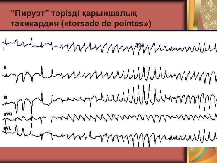 “Пируэт” тәрізді қарыншалық тахикардия ( «torsade de pointes» ) 