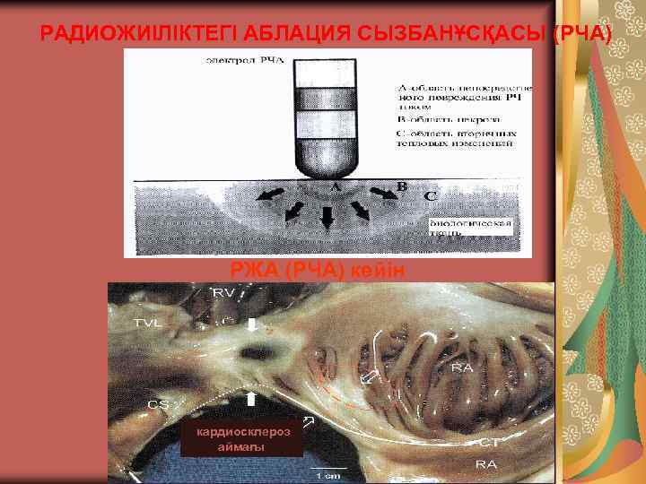 РАДИОЖИІЛІКТЕГІ АБЛАЦИЯ СЫЗБАНҰСҚАСЫ (РЧА) РЖА (РЧА) кейін кардиосклероз аймағы 
