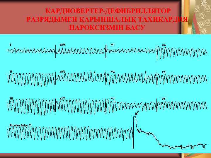 КАРДИОВЕРТЕР-ДЕФИБРИЛЛЯТОР РАЗРЯДЫМЕН ҚАРЫНШАЛЫҚ ТАХИКАРДИЯ ПАРОКСИЗМІН БАСУ 