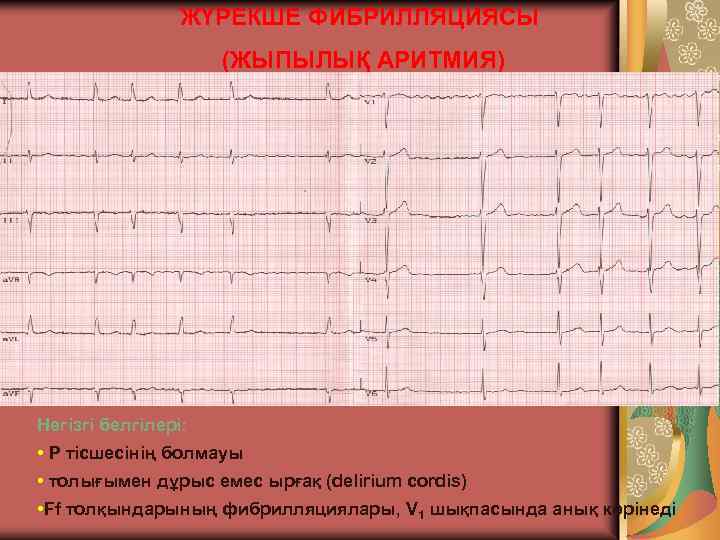 ЖҮРЕКШЕ ФИБРИЛЛЯЦИЯСЫ (ЖЫПЫЛЫҚ АРИТМИЯ) Негізгі белгілері: • Р тісшесінің болмауы • толығымен дұрыс емес