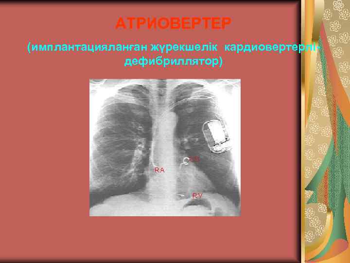 АТРИОВЕРТЕР (имплантацияланған жүрекшелік кардиовертерлідефибриллятор) 