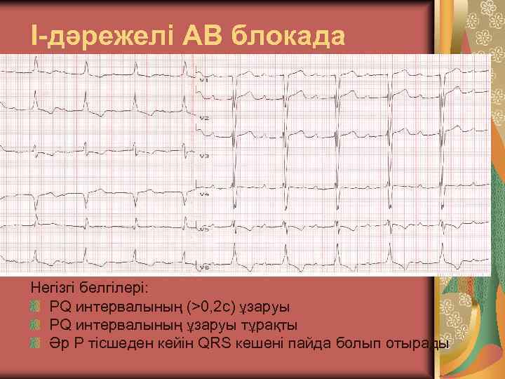 I-дәрежелі АВ блокада Негізгі белгілері: PQ интервалының (>0, 2 с) ұзаруы PQ интервалының ұзаруы