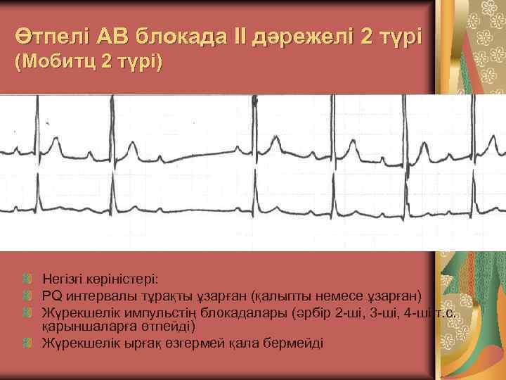 Өтпелі АВ блокада II дәрежелі 2 түрі (Мобитц 2 түрі) Негізгі көріністері: PQ интервалы