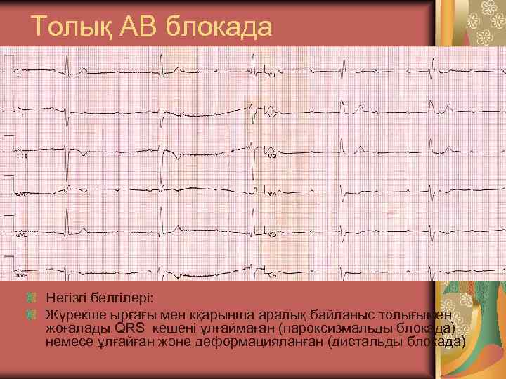 Толық АВ блокада Негізгі белгілері: Жүрекше ырғағы мен ққарынша аралық байланыс толығымен жоғалады QRS
