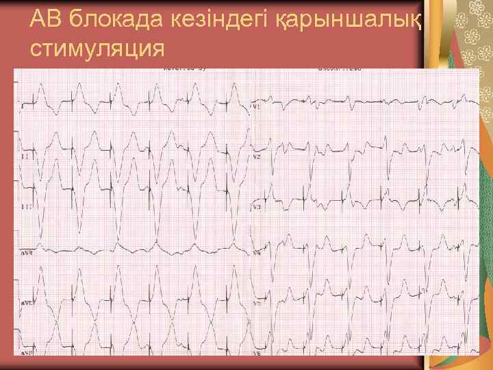 АВ блокада кезіндегі қарыншалық стимуляция 