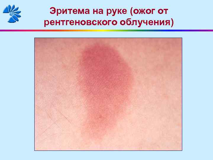 Эритема на руке (ожог от рентгеновского облучения) 