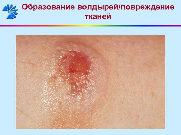Образование волдырей/повреждение тканей 