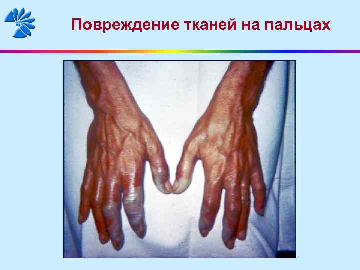 Повреждение тканей на пальцах 