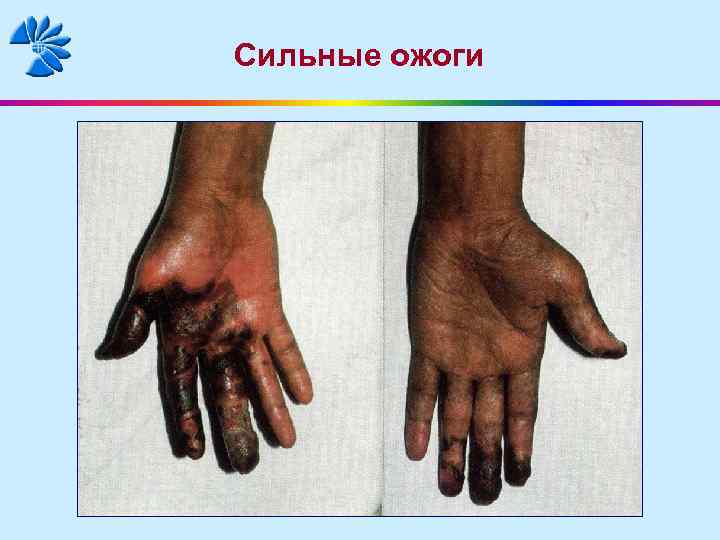 Сильные ожоги 