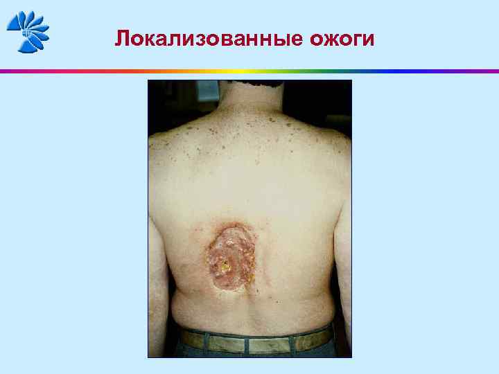Локализованные ожоги 