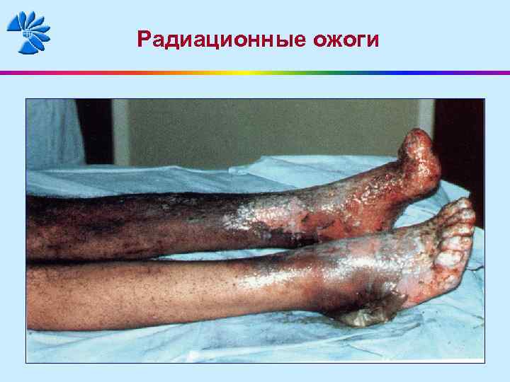 Радиационные ожоги 