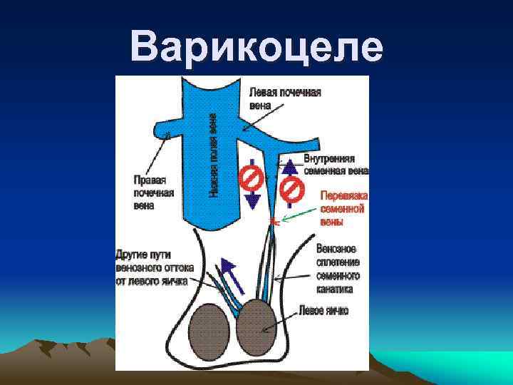 Варикоцеле 