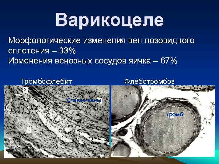 Варикоцеле Морфологические изменения вен лозовидного сплетения – 33% Изменения венозных сосудов яичка – 67%