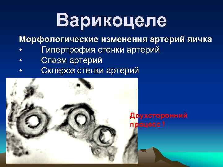 Варикоцеле Морфологические изменения артерий яичка • Гипертрофия стенки артерий • Спазм артерий • Склероз
