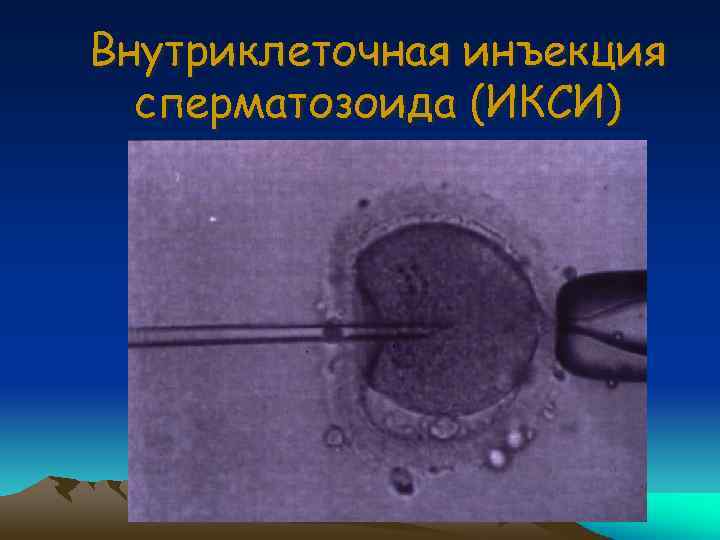 Внутриклеточная инъекция сперматозоида (ИКСИ) 