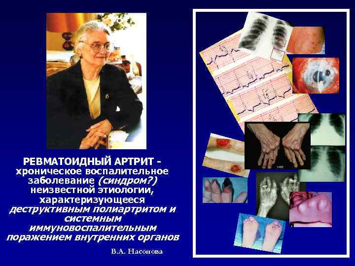 РЕВМАТОИДНЫЙ АРТРИТ хроническое воспалительное заболевание (синдром? ) неизвестной этиологии, характеризующееся деструктивным полиартритом и системным