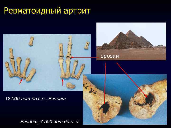 Ревматоидный артрит эрозии 12 000 лет до н. э. , Египет, 7 500 лет