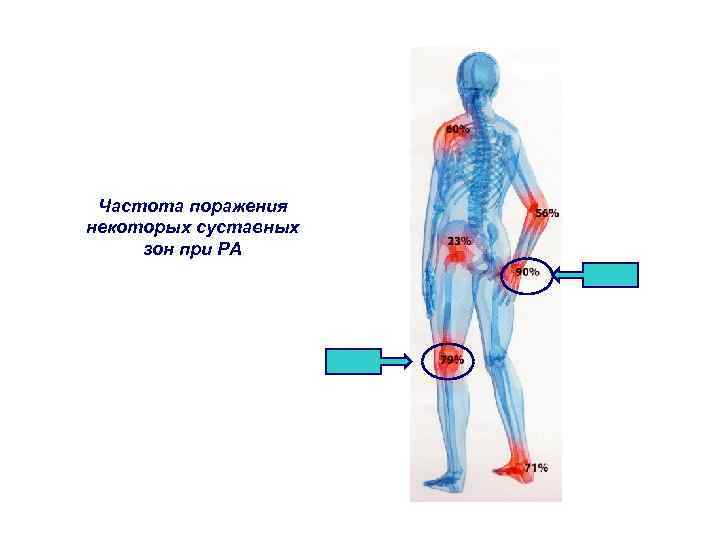 Частота поражения некоторых суставных зон при РА 