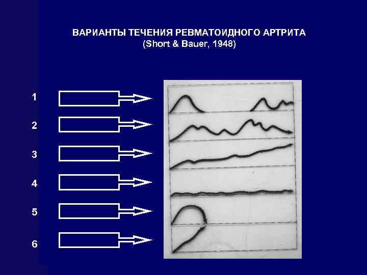 ВАРИАНТЫ ТЕЧЕНИЯ РЕВМАТОИДНОГО АРТРИТА (Short & Bauer, 1948) 1 2 3 4 5 6