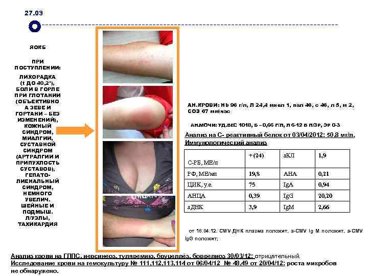 27. 03 ЯОКБ ПРИ ПОСТУПЛЕНИИ: ЛИХОРАДКА (t ДО 40, 2°), БОЛИ В ГОРЛЕ ПРИ