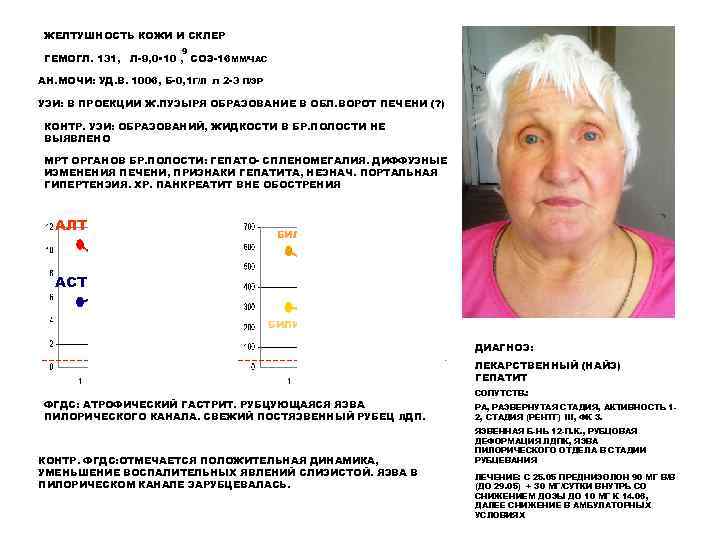 ЖЕЛТУШНОСТЬ КОЖИ И СКЛЕР 9 ГЕМОГЛ. 131, Л-9, 0 • 10 , СОЭ-16 ММ/ЧАС