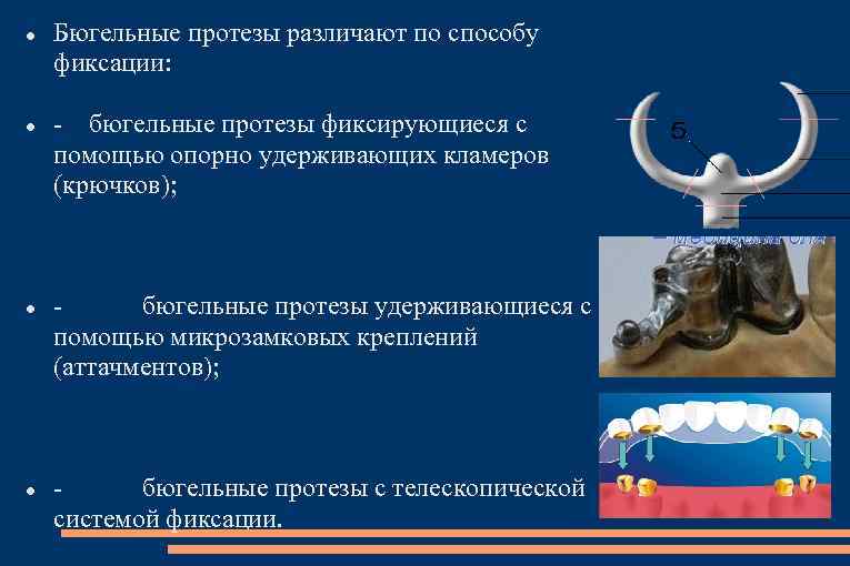  Бюгельные протезы различают по способу фиксации: - бюгельные протезы фиксирующиеся с помощью опорно