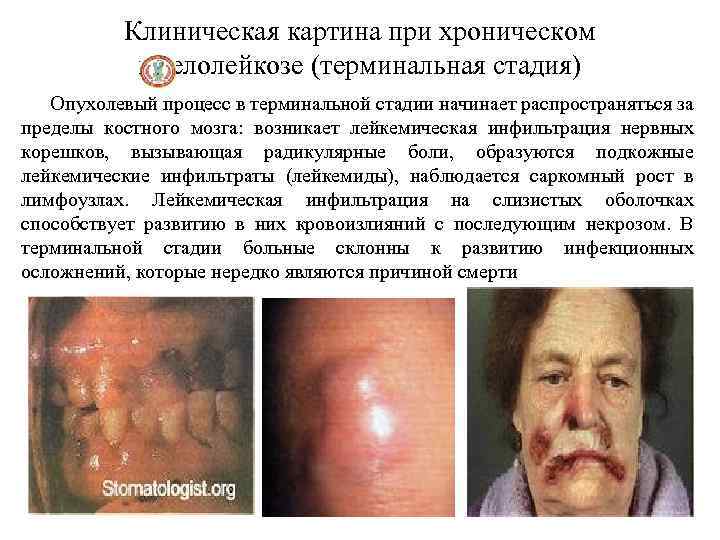 Клиническая картина при хроническом миелолейкозе (терминальная стадия) Опухолевый процесс в терминальной стадии начинает распространяться